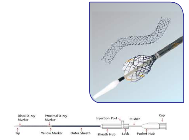 PALLIATOR BILIARY STENTS